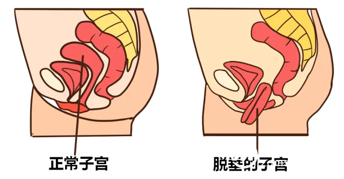 耄耋老人子宫脱垂,妇科巧手化解“危机” 耄耋老人子宫脱垂,妇科巧手化解“危机”