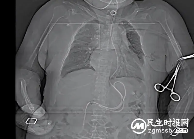 湘潭县人民医院重症医学科成功开展徒手盲插鼻空肠管术