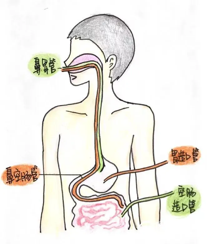 湘潭县人民医院重症医学科成功开展徒手盲插鼻空肠管术