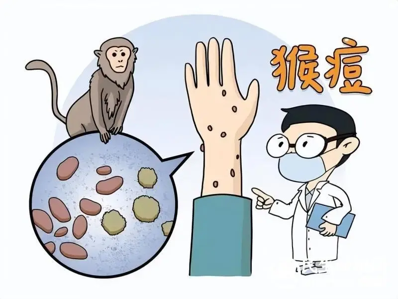 都在说猴痘，猴痘是什么？如何预防？