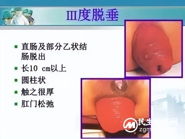 湘潭市中医医院完成首例Ⅲ度直肠脱垂Altemeier术 湘潭市中医医院完成首例Ⅲ度直肠脱垂Altemeier术