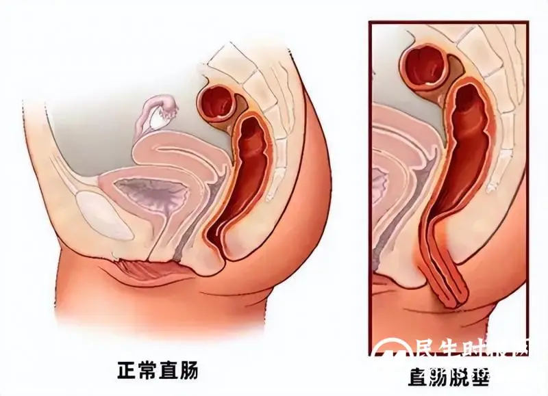 湘潭市中医医院完成首例Ⅲ度直肠脱垂Altemeier术 湘潭市中医医院完成首例Ⅲ度直肠脱垂Altemeier术