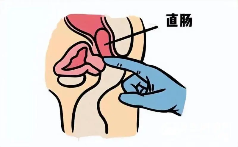 【医学科普】让人羞羞的“肛门指检”竟能查出这么多病? 【医学科普】让人羞羞的“肛门指检”竟能查出这么多病?