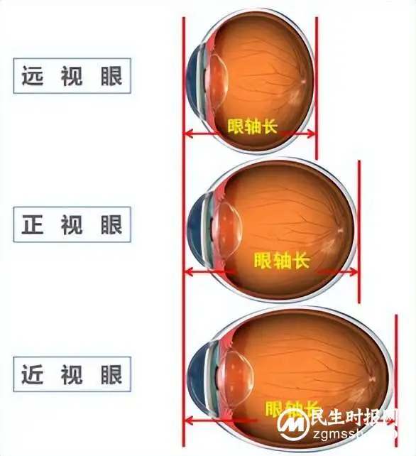 小长假必备眼健康检查:远视储备——孩子与生俱来的“视力银行” 小长假必备眼健康检查:远视储备——孩子与生俱来的“视力银行”