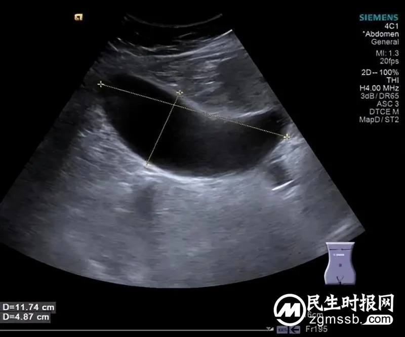【卓越医疗】我院超声科完成超声引导下经皮经肝胆囊造瘘术 【卓越医疗】我院超声科完成超声引导下经皮经肝胆囊造瘘术