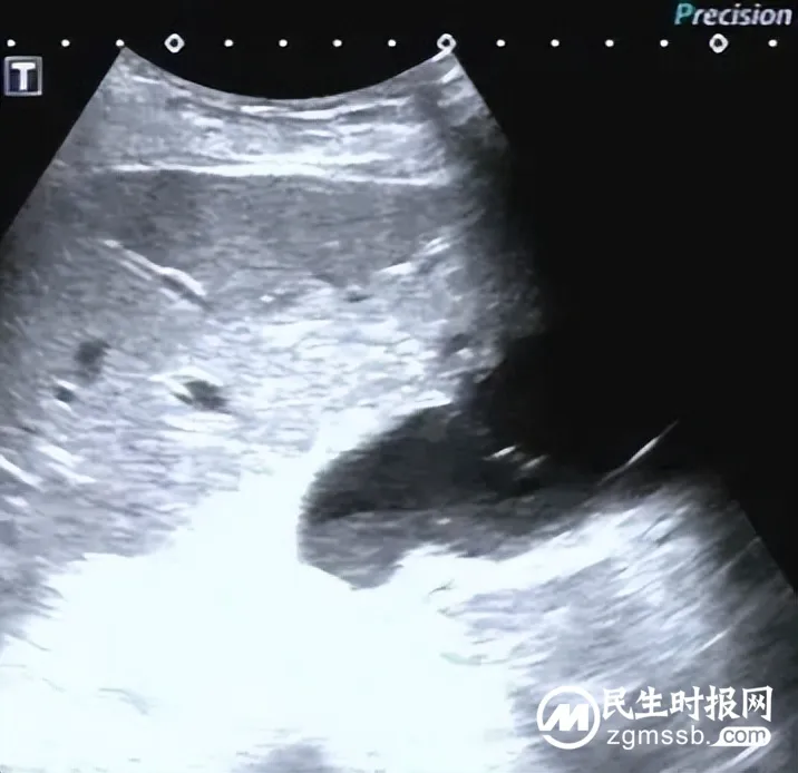 【卓越医疗】我院超声科完成超声引导下经皮经肝胆囊造瘘术 【卓越医疗】我院超声科完成超声引导下经皮经肝胆囊造瘘术
