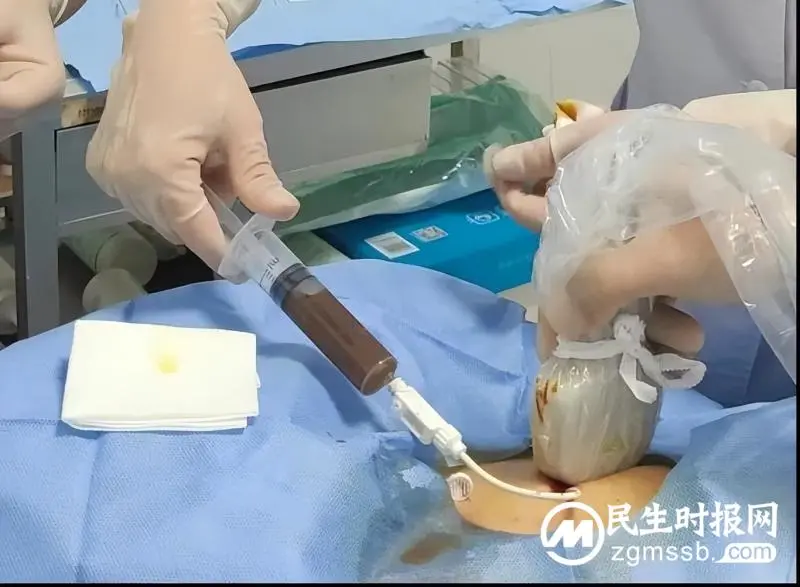 【卓越医疗】我院超声科完成超声引导下经皮经肝胆囊造瘘术 【卓越医疗】我院超声科完成超声引导下经皮经肝胆囊造瘘术