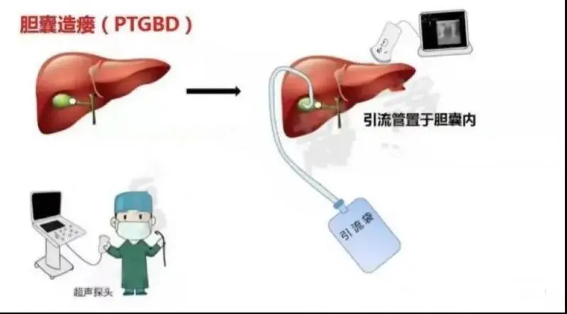 【卓越医疗】我院超声科完成超声引导下经皮经肝胆囊造瘘术 【卓越医疗】我院超声科完成超声引导下经皮经肝胆囊造瘘术