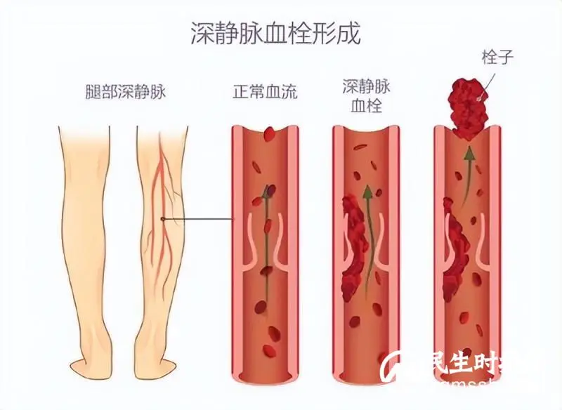 【卓越护理】医患携手,预防VTE 【卓越护理】医患携手,预防VTE