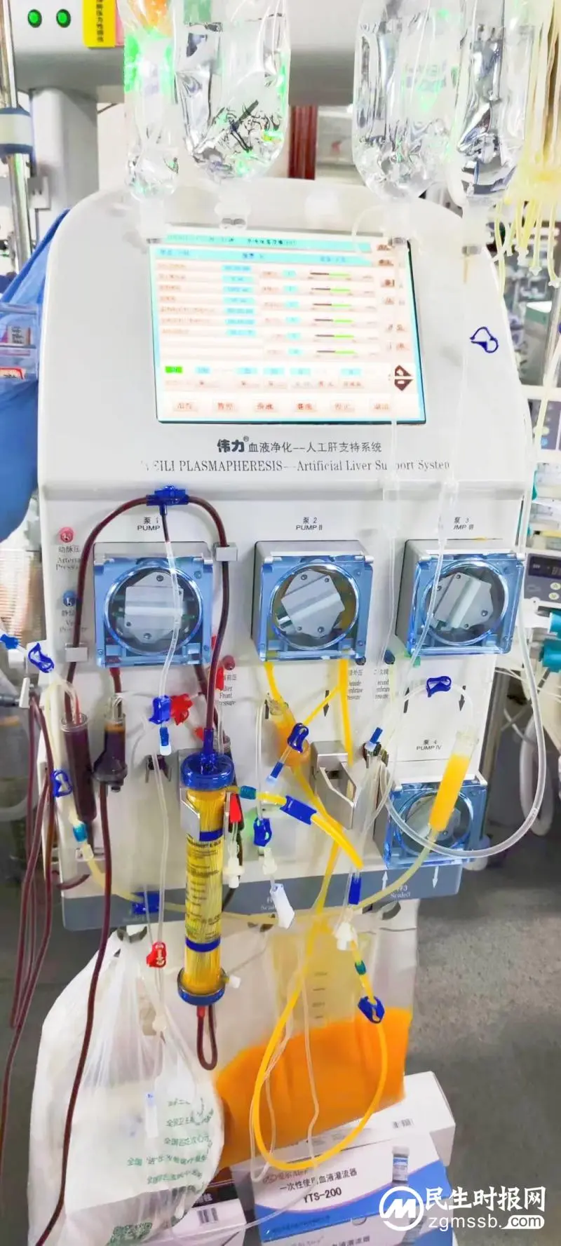湘潭市中心医院运用“人工肝”技术成功救治一例重症甲亢危象合并肝衰竭患者 湘潭市中心医院运用“人工肝”技术成功救治一例重症甲亢危象合并肝衰竭患者