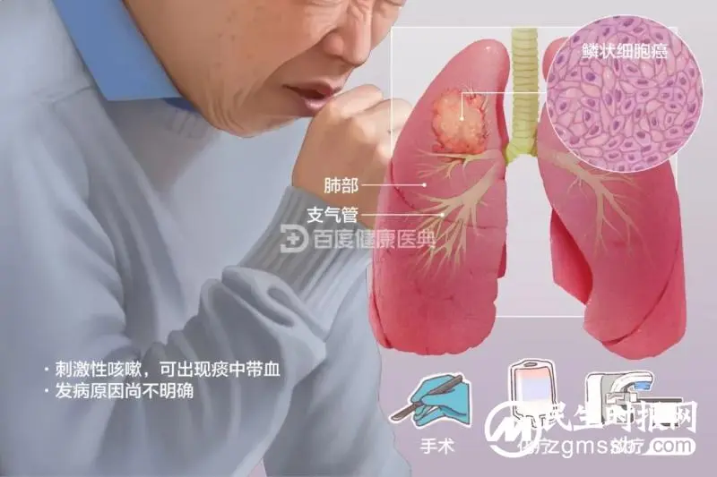 “私人”定制，拿下肺癌！