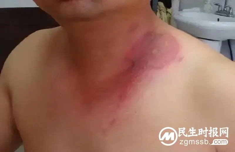 男子皮肤多处溃烂,只因随手捏死一只虫子..... 男子皮肤多处溃烂,只因随手捏死一只虫子.....