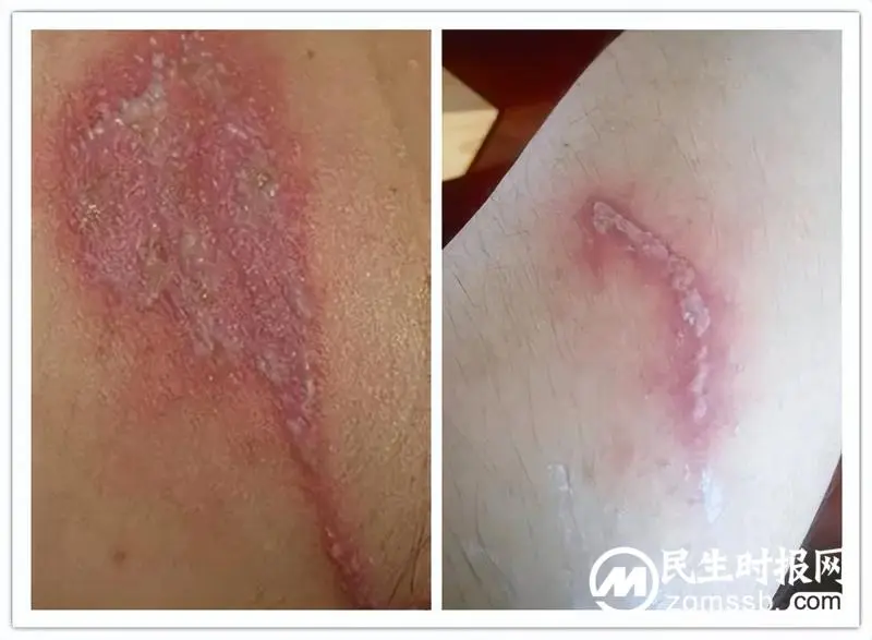 男子皮肤多处溃烂,只因随手捏死一只虫子..... 男子皮肤多处溃烂,只因随手捏死一只虫子.....