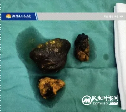 柿子吃多了会怎么样?医生: 警惕“柿石症” 柿子吃多了会怎么样?医生: 警惕“柿石症”