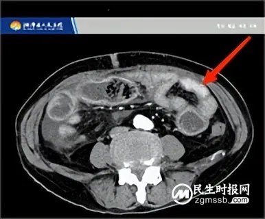 柿子吃多了会怎么样?医生: 警惕“柿石症” 柿子吃多了会怎么样?医生: 警惕“柿石症”