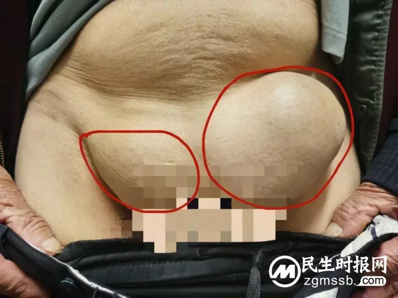 跨学科智慧:MDT团队为复杂疝患者解锁新希望 跨学科智慧:MDT团队为复杂疝患者解锁新希望