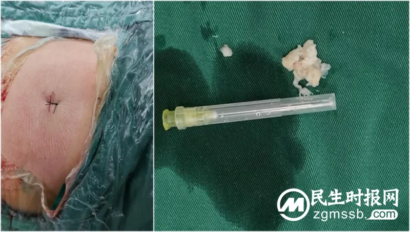 【中医•医者红】脊柱病科完成首例高位腰椎间盘突出症脊柱内镜手术 【中医•医者红】脊柱病科完成首例高位腰椎间盘突出症脊柱内镜手术
