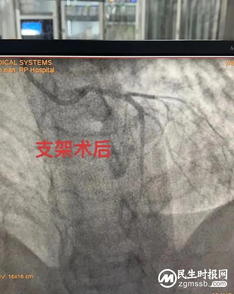 【卓越医疗】男子突发左主干病变心肌梗死，我院胸痛中心成功救治，化险为夷！