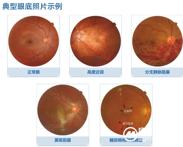 这张“照片”藏着大秘密!这些人不定期查眼底,后果可能很严重 这张“照片”藏着大秘密!这些人不定期查眼底,后果可能很严重