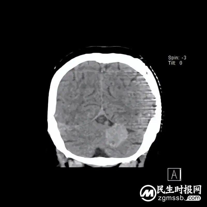 我院颅脑心胸外科团队成功为一名左侧小脑天幕骑跨型脑膜瘤患者实施肿瘤切除术