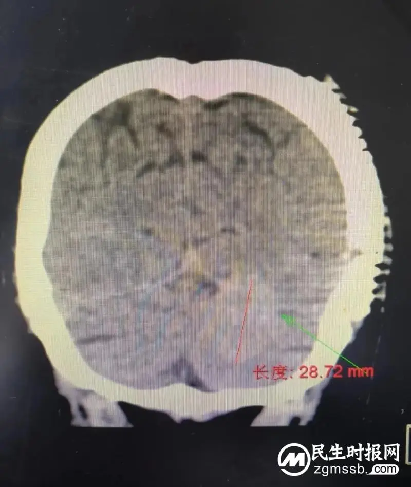 我院颅脑心胸外科团队成功为一名左侧小脑天幕骑跨型脑膜瘤患者实施肿瘤切除术