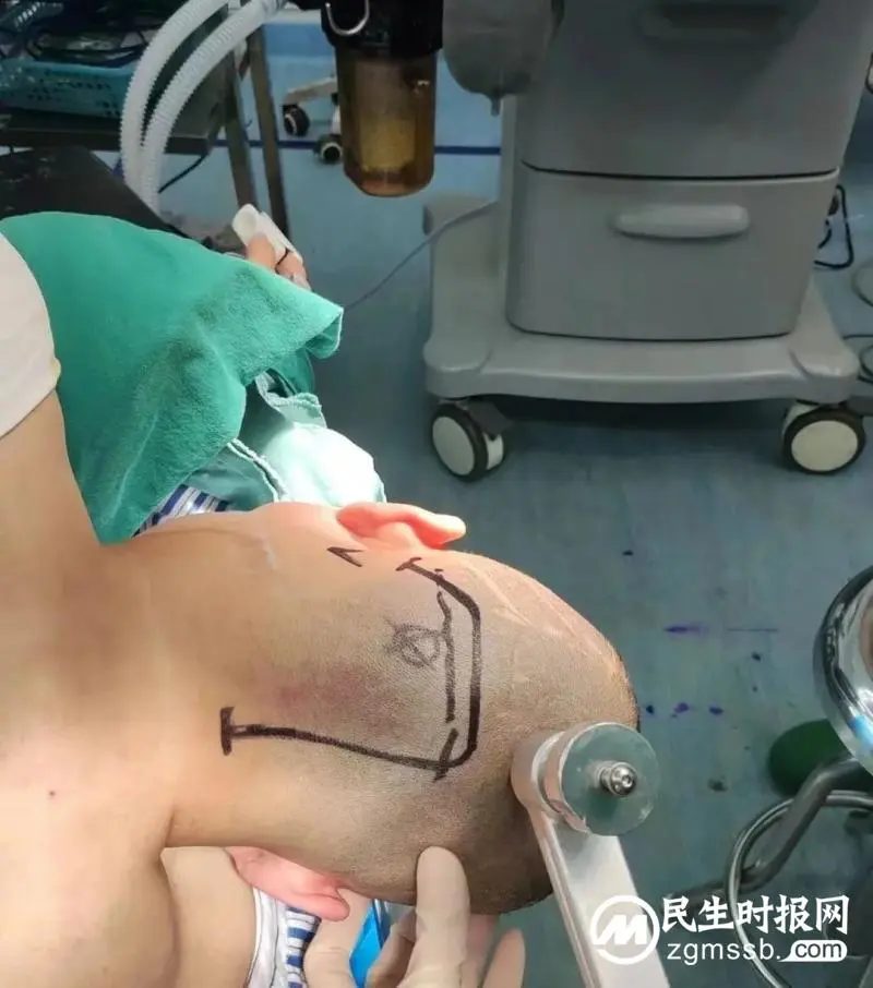 我院颅脑心胸外科团队成功为一名左侧小脑天幕骑跨型脑膜瘤患者实施肿瘤切除术
