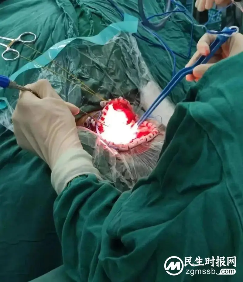 我院颅脑心胸外科团队成功为一名左侧小脑天幕骑跨型脑膜瘤患者实施肿瘤切除术