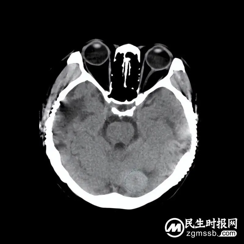 我院颅脑心胸外科团队成功为一名左侧小脑天幕骑跨型脑膜瘤患者实施肿瘤切除术
