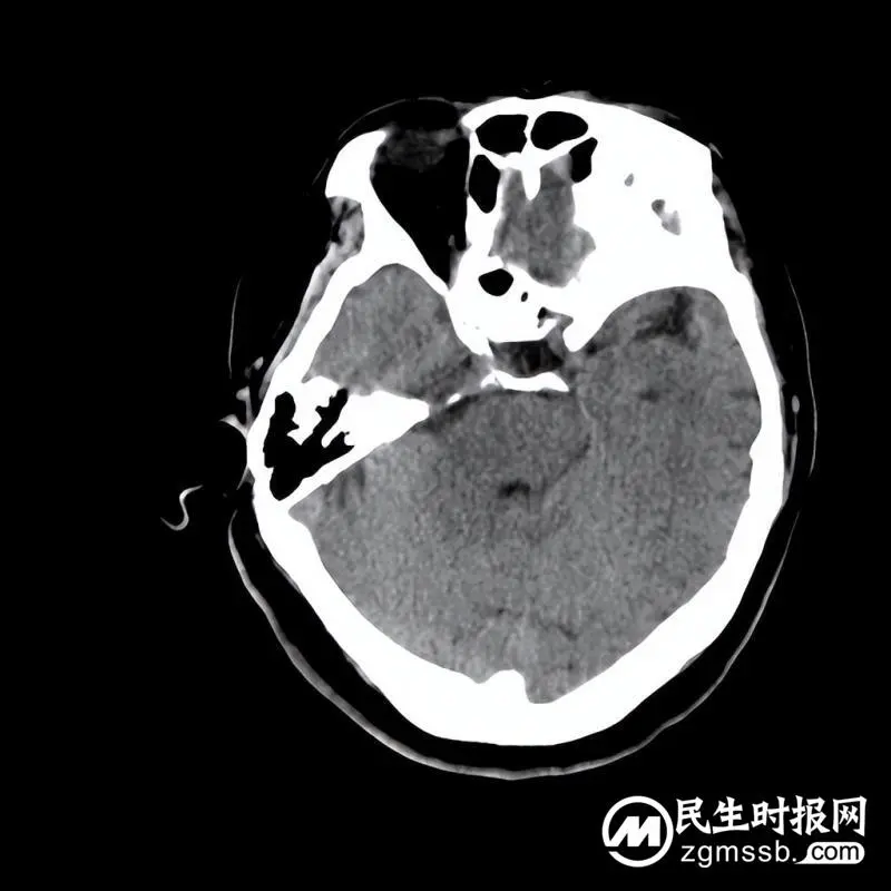 我院颅脑心胸外科团队成功为一名左侧小脑天幕骑跨型脑膜瘤患者实施肿瘤切除术