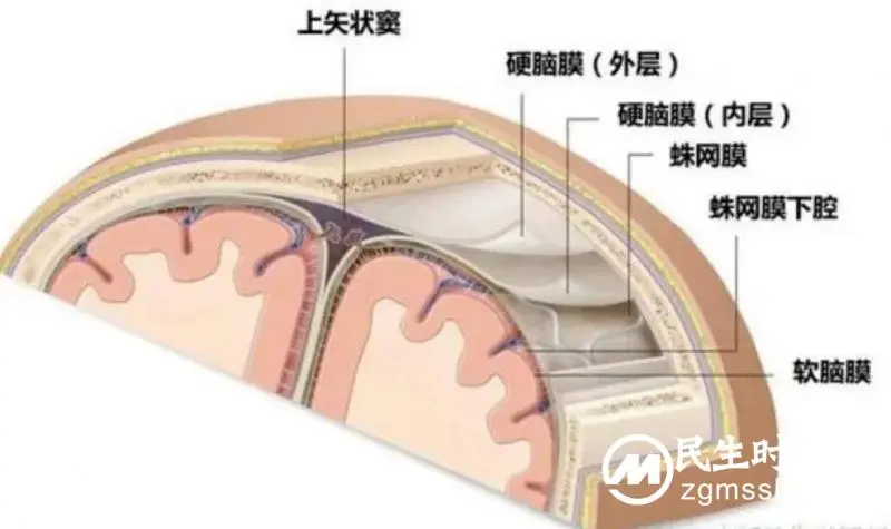 我院颅脑心胸外科团队成功为一名左侧小脑天幕骑跨型脑膜瘤患者实施肿瘤切除术