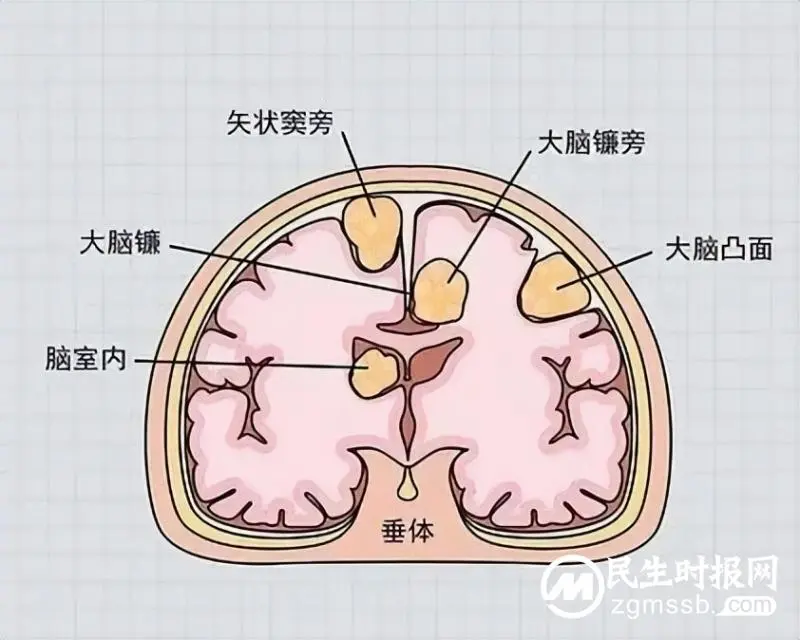 我院颅脑心胸外科团队成功为一名左侧小脑天幕骑跨型脑膜瘤患者实施肿瘤切除术