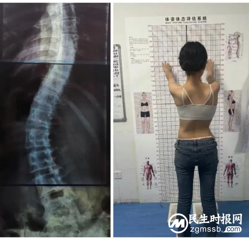 寒假怎么过?2024年脊柱侧弯及不良体态矫正冬令营开班啦! 寒假怎么过?2024年脊柱侧弯及不良体态矫正冬令营开班啦!