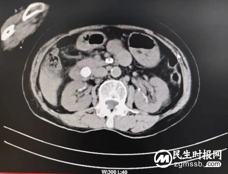 【卓越医疗】内窥镜中心成功实施ICU床旁ERCP术,救治一名急性梗阻化脓性胆管炎重症患者 【卓越医疗】内窥镜中心成功实施ICU床旁ERCP术,救治一名急性梗阻化脓性胆管炎重症患者