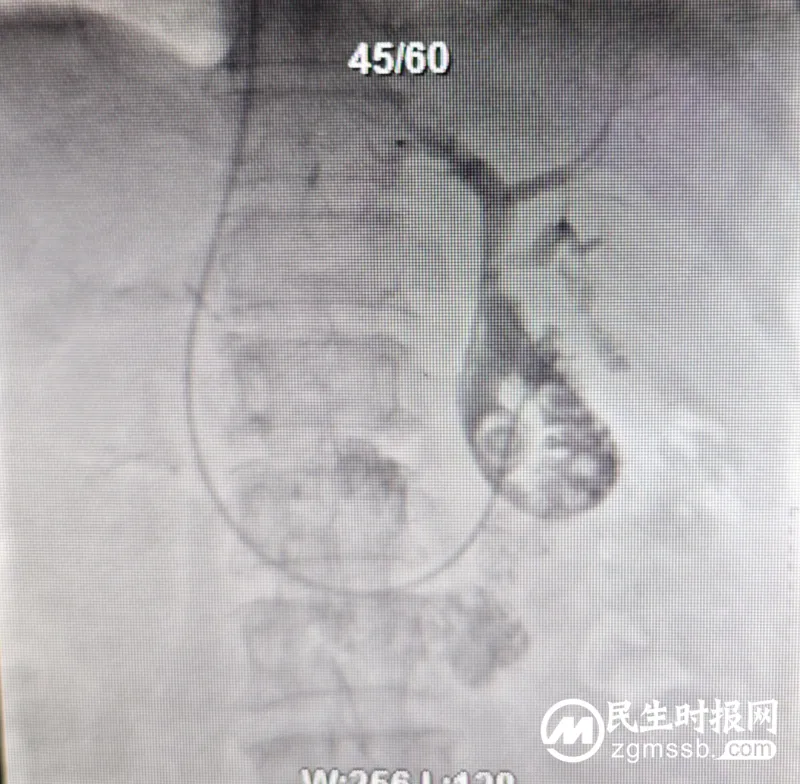 【卓越医疗】内窥镜中心成功实施ICU床旁ERCP术,救治一名急性梗阻化脓性胆管炎重症患者 【卓越医疗】内窥镜中心成功实施ICU床旁ERCP术,救治一名急性梗阻化脓性胆管炎重症患者