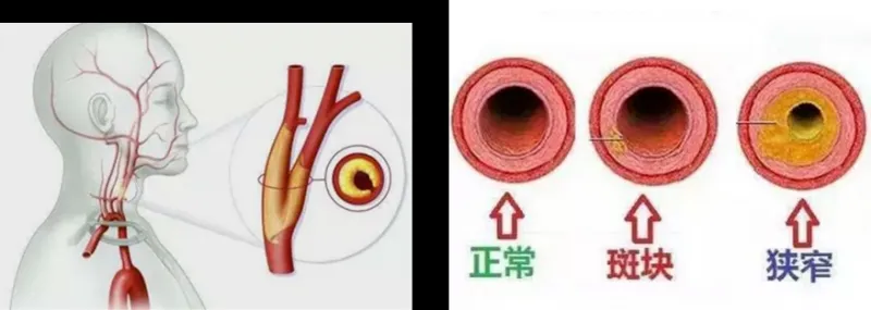 撑起“一线天”:颈内动脉狭窄血管支架置入术 撑起“一线天”:颈内动脉狭窄血管支架置入术