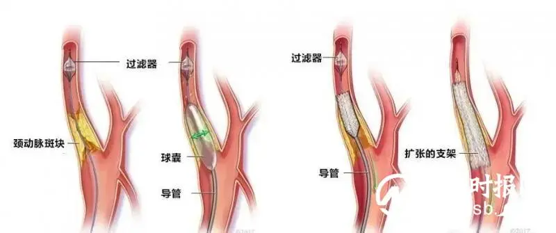 撑起“一线天”:颈内动脉狭窄血管支架置入术 撑起“一线天”:颈内动脉狭窄血管支架置入术