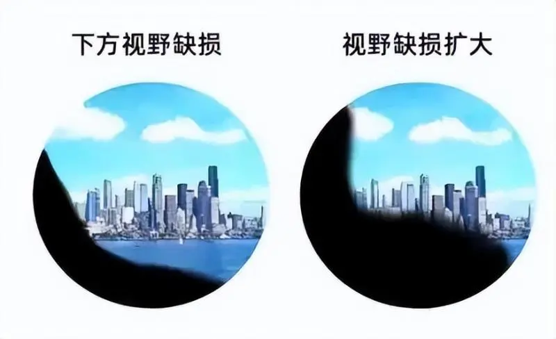 眼前黑影飘啊飘,当心视网膜脱离 眼前黑影飘啊飘,当心视网膜脱离