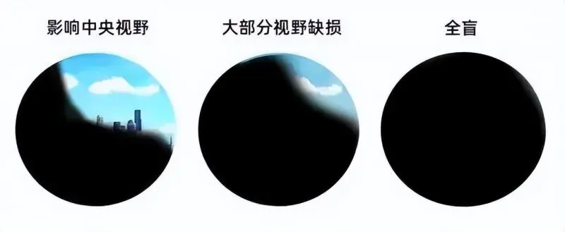 眼前黑影飘啊飘,当心视网膜脱离 眼前黑影飘啊飘,当心视网膜脱离