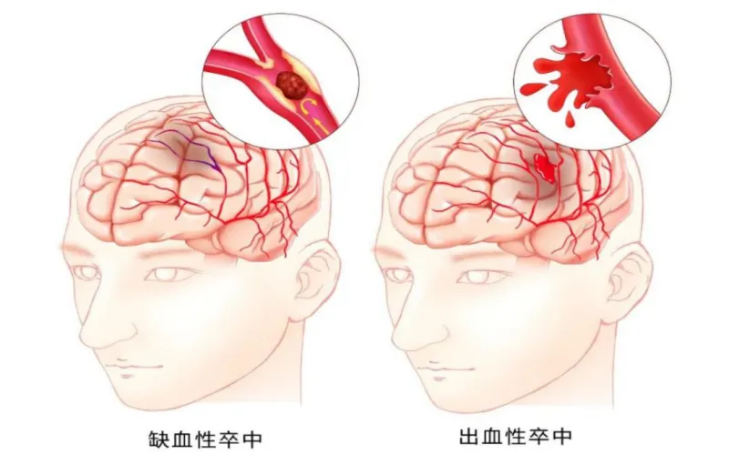 青少年猝死:脑血管意外,注意这些征兆! 青少年猝死:脑血管意外,注意这些征兆!