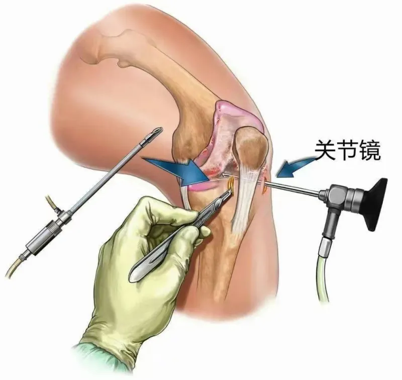 你敢信?膝关节骨折,术后仅三天就出院 你敢信?膝关节骨折,术后仅三天就出院