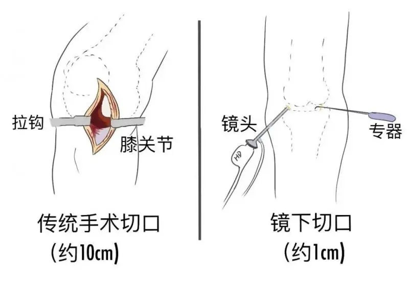 你敢信?膝关节骨折,术后仅三天就出院 你敢信?膝关节骨折,术后仅三天就出院