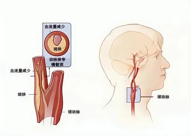 【中心医院·医者红】切开颈部“拆炸弹” 疏通血管“除病根” 【中心医院·医者红】切开颈部“拆炸弹” 疏通血管“除病根”
