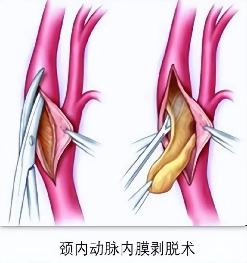 【中心医院·医者红】切开颈部“拆炸弹” 疏通血管“除病根” 【中心医院·医者红】切开颈部“拆炸弹” 疏通血管“除病根”