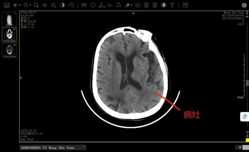 【中医·医者红】“年龄不是问题”——中西结合为82岁急性脑梗患者保驾护航 【中医·医者红】“年龄不是问题”——中西结合为82岁急性脑梗患者保驾护航