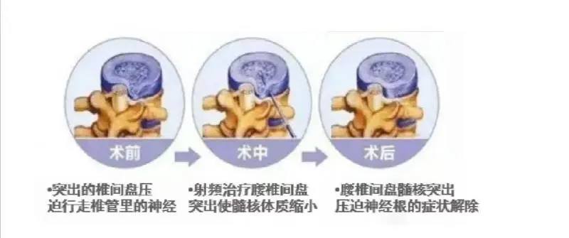 接受了这项治疗，他摆脱了9年的腰痛