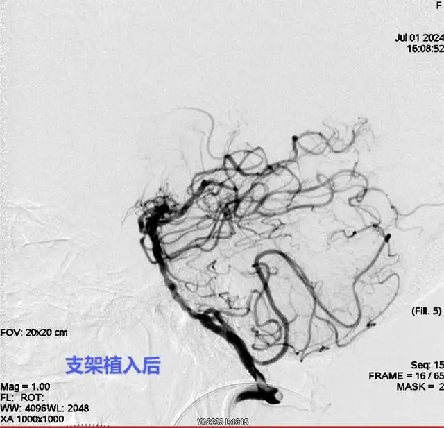 【卓越医疗】湘潭县人民医院卒中团队：精准“拆弹”与“架桥” 为脑血管疾病患者保驾护航