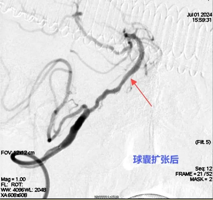 人医卒中团队:精准“拆弹”与“架桥” 为脑血管疾病患者保驾护航 人医卒中团队:精准“拆弹”与“架桥” 为脑血管疾病患者保驾护航