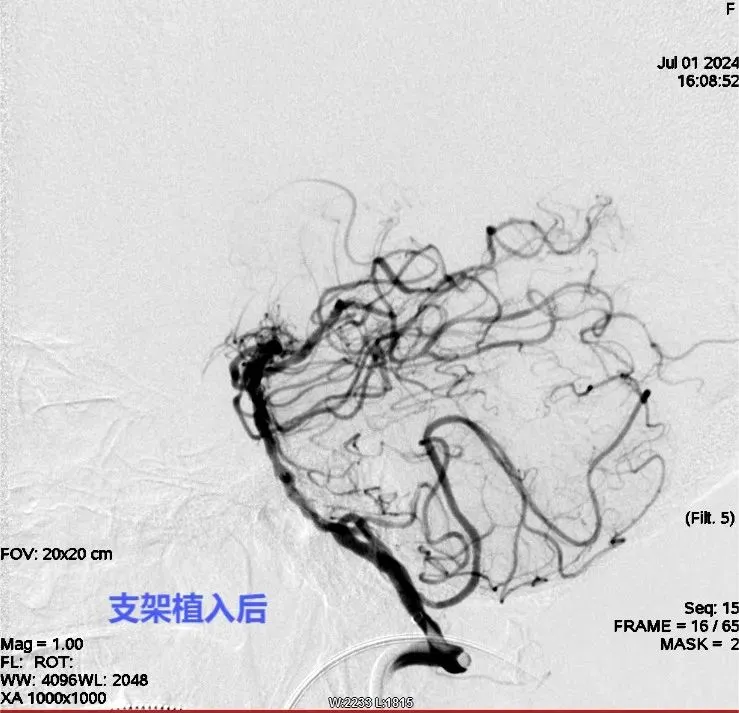 人医卒中团队:精准“拆弹”与“架桥” 为脑血管疾病患者保驾护航 人医卒中团队:精准“拆弹”与“架桥” 为脑血管疾病患者保驾护航