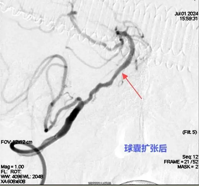 【卓越医疗】湘潭县人民医院卒中团队：精准“拆弹”与“架桥” 为脑血管疾病患者保驾护航