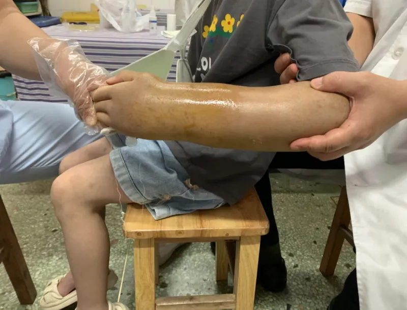 【卓越医疗】小儿骨折莫惊慌,中医正骨来帮忙 【卓越医疗】小儿骨折莫惊慌,中医正骨来帮忙